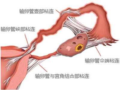 输卵管粘连能治好吗